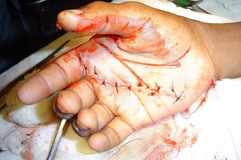 hand injury